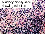 Biopsy slide showing rejection