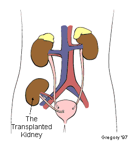 Transplanted kidney